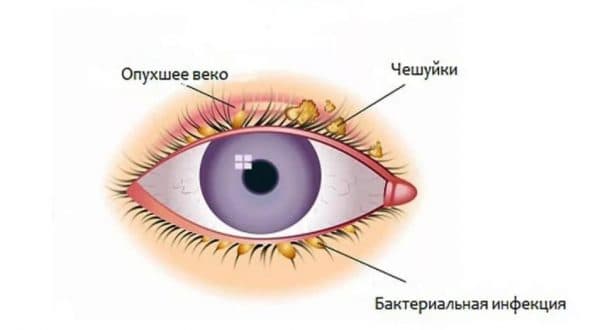 Лечение блефарита глазными каплями Катахром
